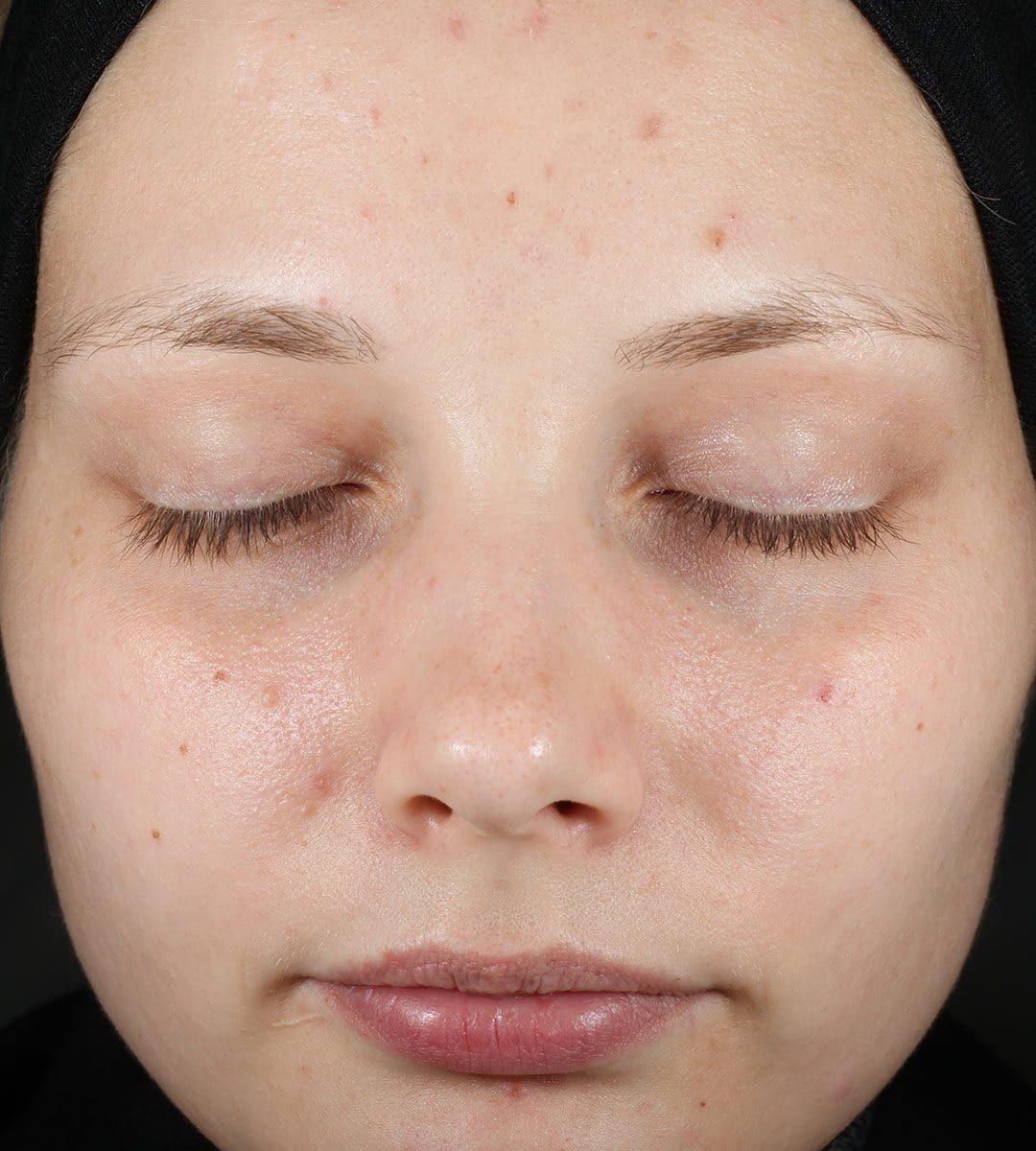 Az Eucerin DermoPure Bőrmegújító szérummal való kezelés előtt és után