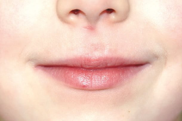 Lips after treatment with Eucerin Acute Lip Balm