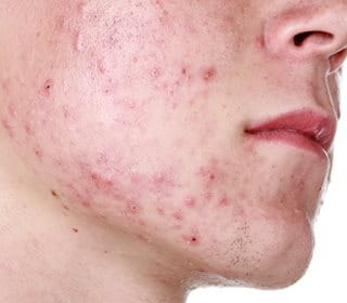 adolescente com acne moderada