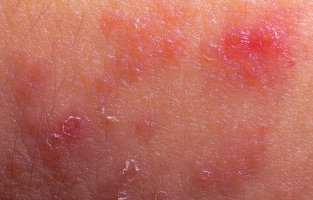  Dermatite Atópica 