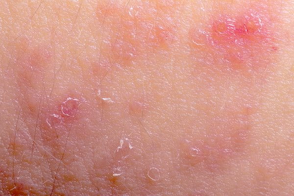 closeup image of eczema
