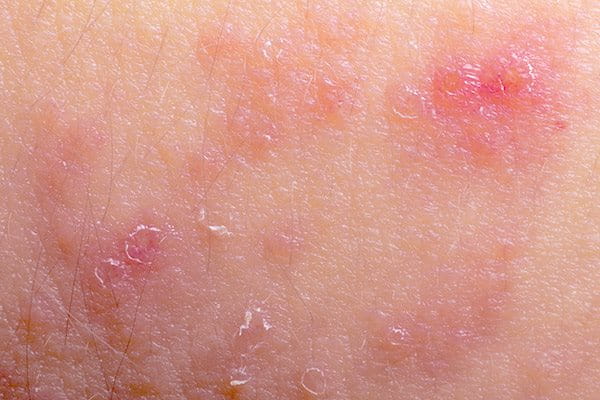 Eczema flare-up
