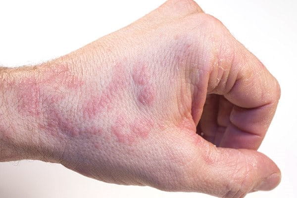 Eczema on a person's hand