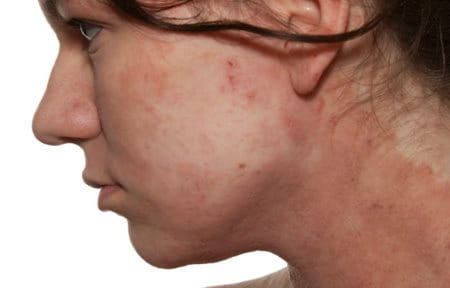dermatitis na licu