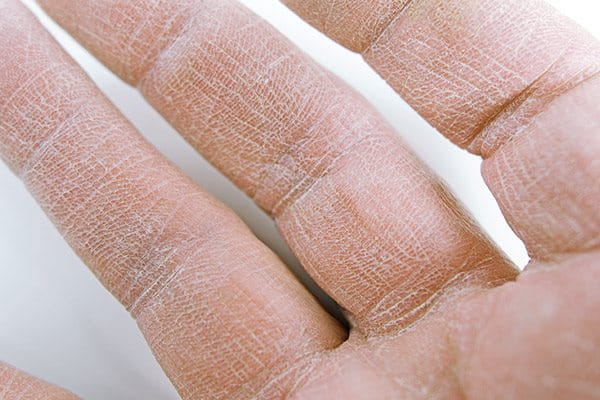 Mycket torra fingrar med sprucken hud