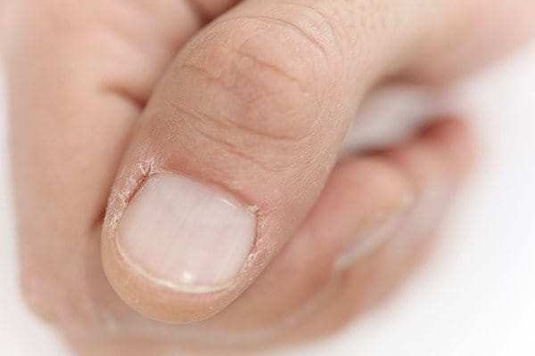 Gebarsten huid op de duim: nagelriemen