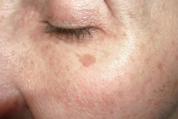 Traitement laser : hyperpigmentation