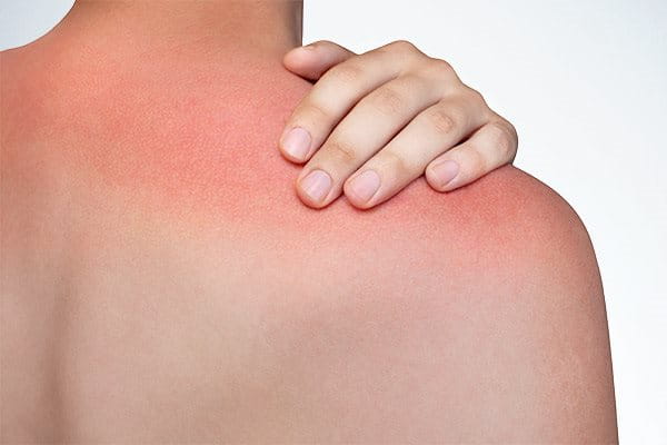Oparzenie skóry: oparzenie słoneczne na plecach