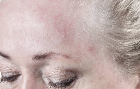 Woman´s scaly forehead