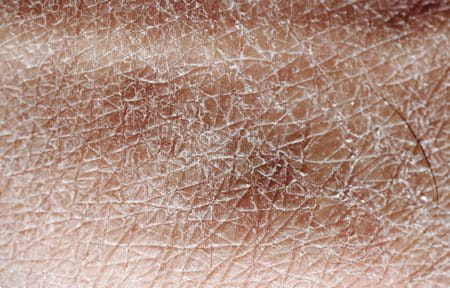 Close-up from very dry skin