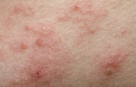 Close-up from red and dry skin with plaques