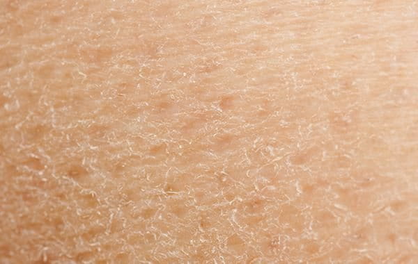 droge huid veroorzaakt jeukende huid