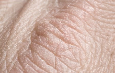 Close-up from dry skin on hands