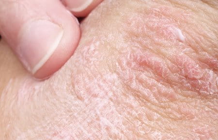 Close-up from red and dry skin area