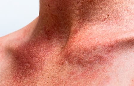 Rote Stellen im Decolleté oder im Gesicht können auch eine allergische Reaktion sein.