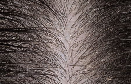 Scalp with thinning hair