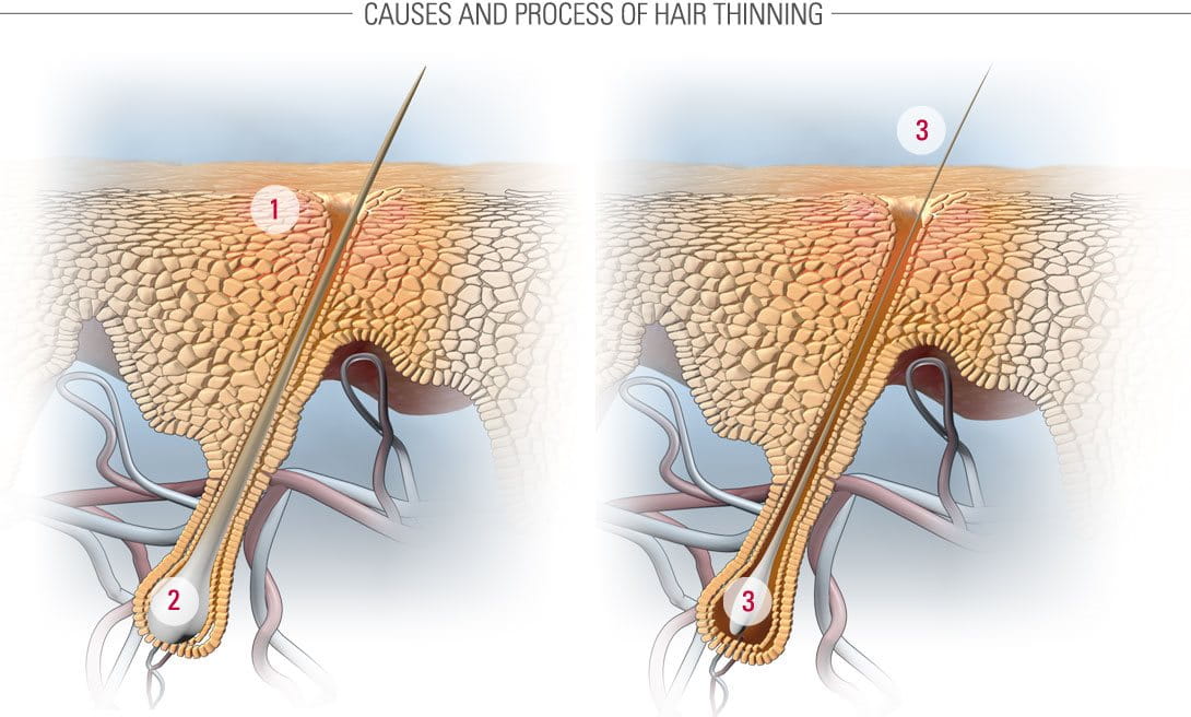 How thinning hair develops