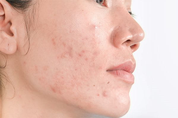 Hyperpigmentation on the face
