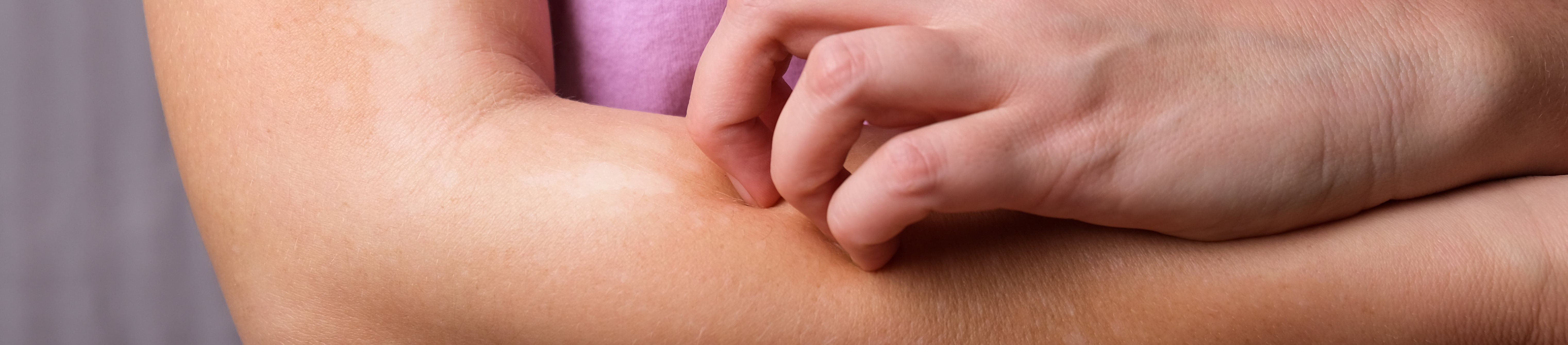 Frau kratzt sich am Unterarm