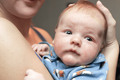 Baby mit roten Stellen im Gesicht/Neurodermitis
