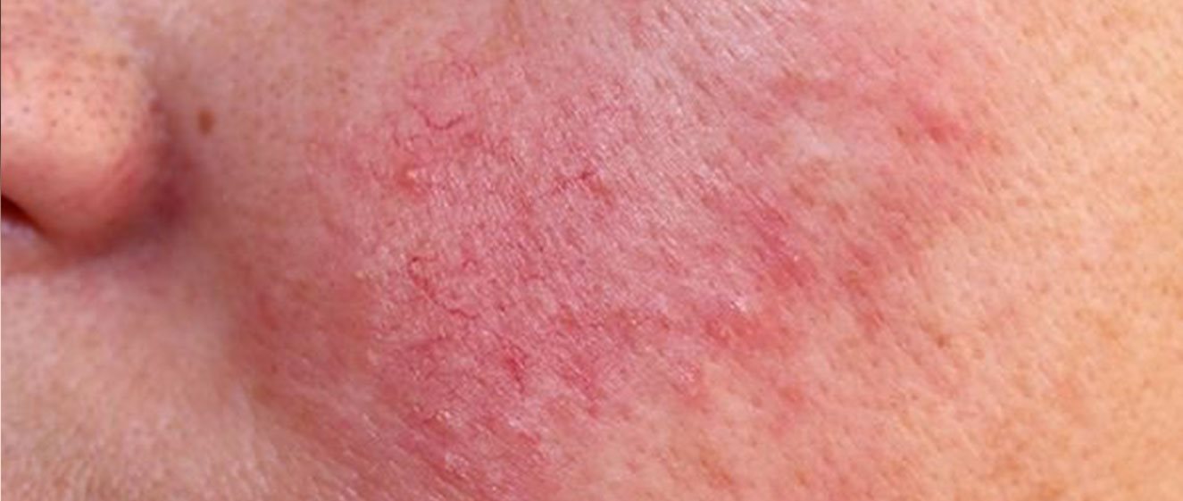 Von Rosacea betroffene Wangenpartie im Gesicht