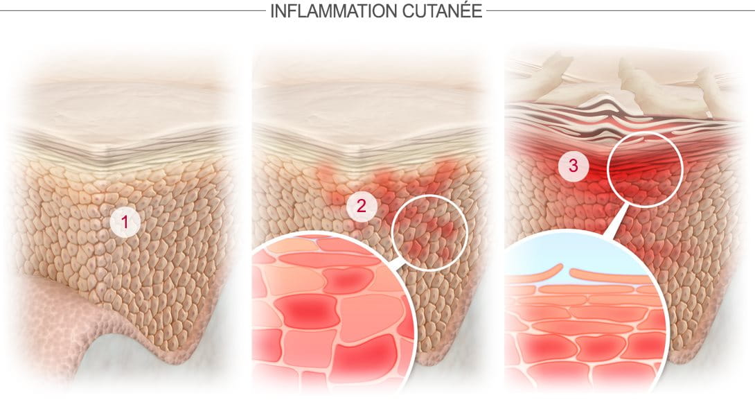 Iflammation cutanée