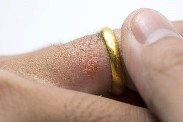 Бижутата могат да причинят алергичен контактен дерматит по ръцете