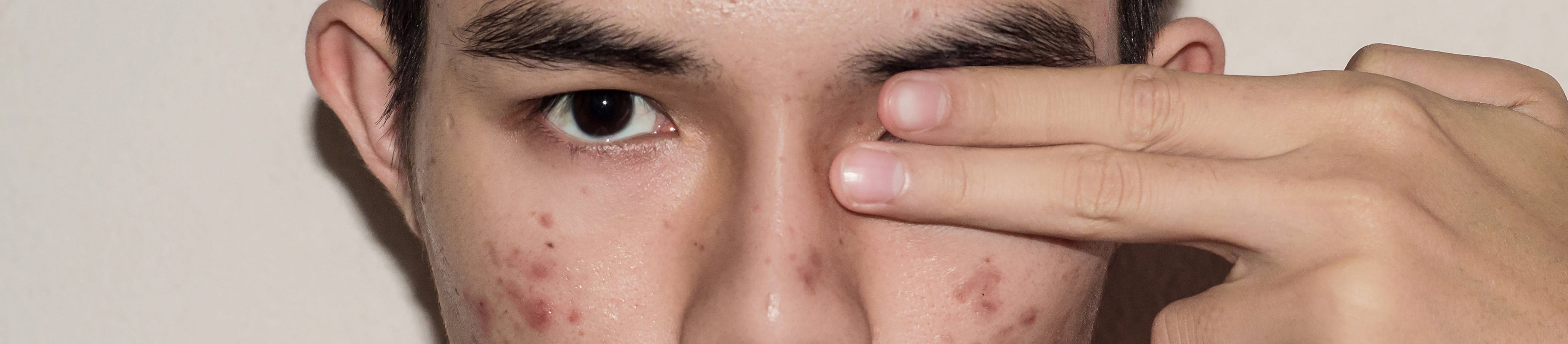 Influência do clima brasileiro na formação de acne, cravos e espinhas.