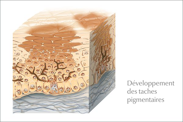 Evolution des taches pigmentaires dans la peau