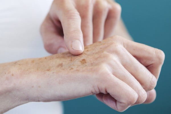 Gros plan sur une main présentant des taches de vieillesse.