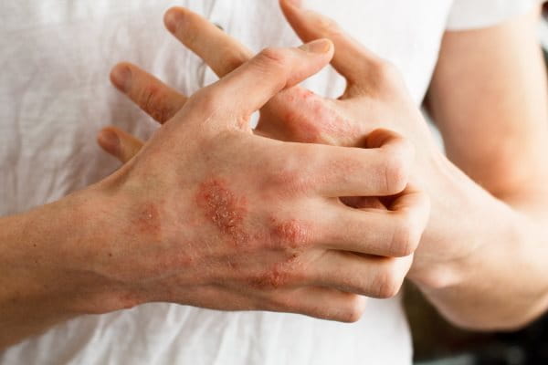 Allergisches Kontaktekzem and den Händen