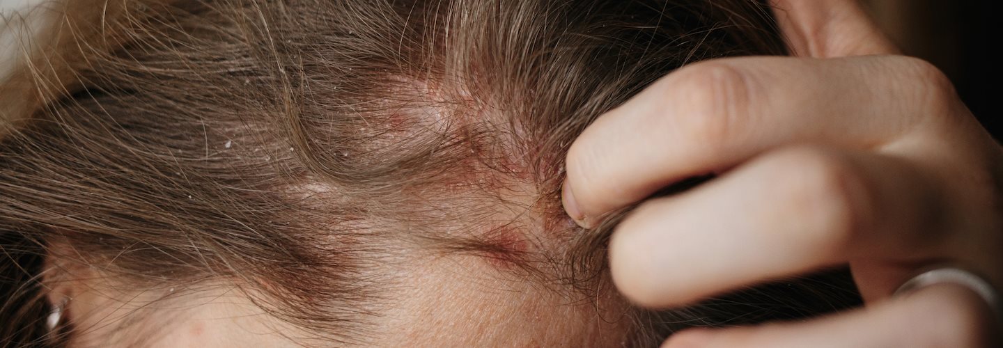 Schuppenflechte Kopfhaut