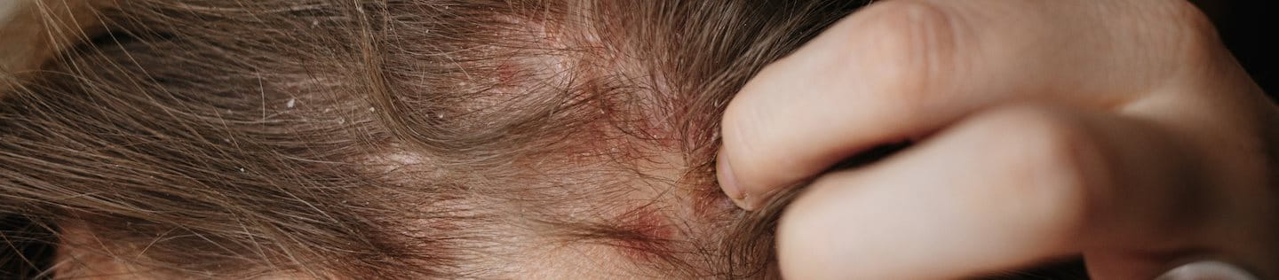 Schuppenflechte Kopfhaut