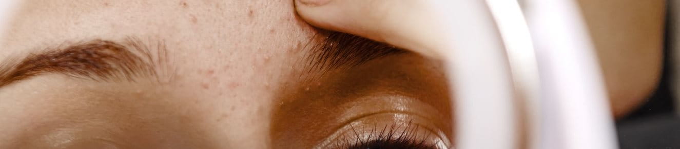 Akneformen Behandlung