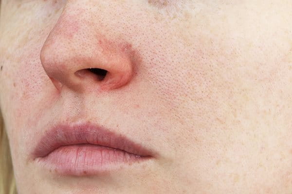 Couperose: Rötungen an Nase und Wangen