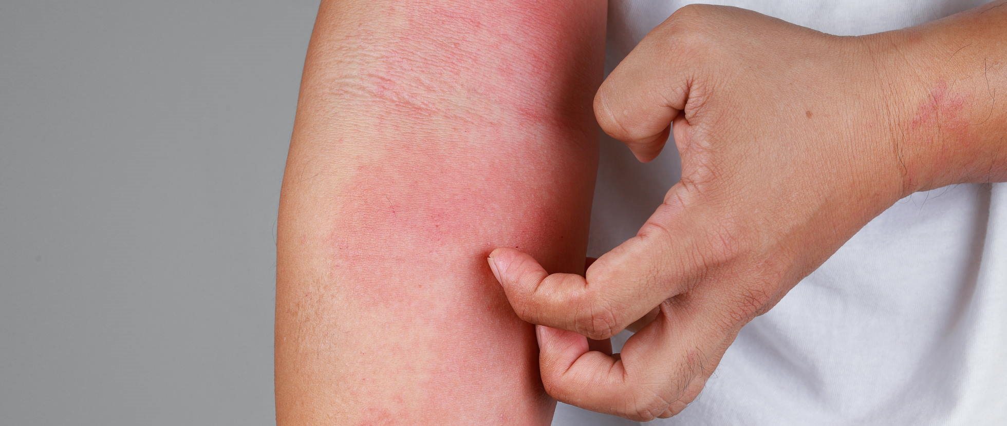 Mensch kratzt sich am Arm mit Hautausschlag