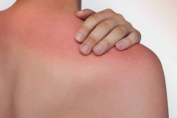Person mit Sonnenbrand auf der Schulter