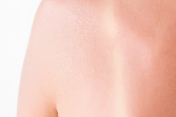 Leichter Sonnenbrand auf dem Rücken einer Frau