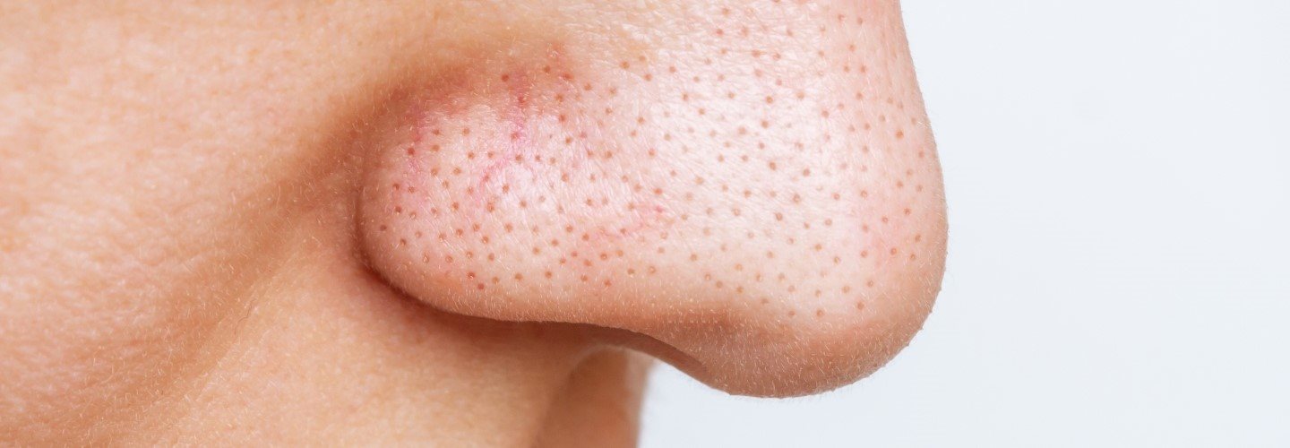 Bild einer Nase mit Blackheads.