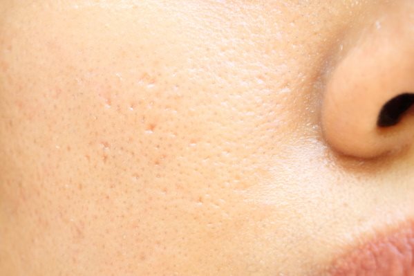 Fettige Haut im Gesicht mit großen Poren