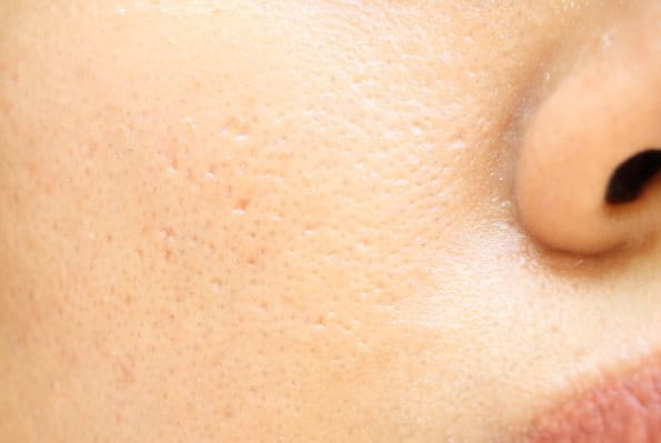 Fettige Haut im Gesicht mit großen Poren