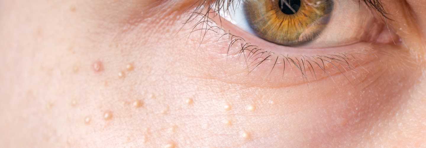 Milien unter dem Auge