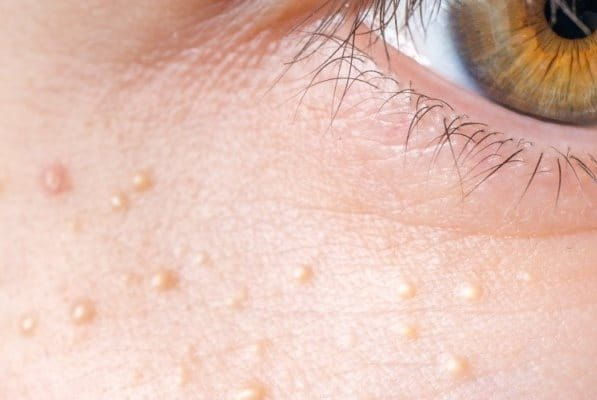 Milien unter dem Auge