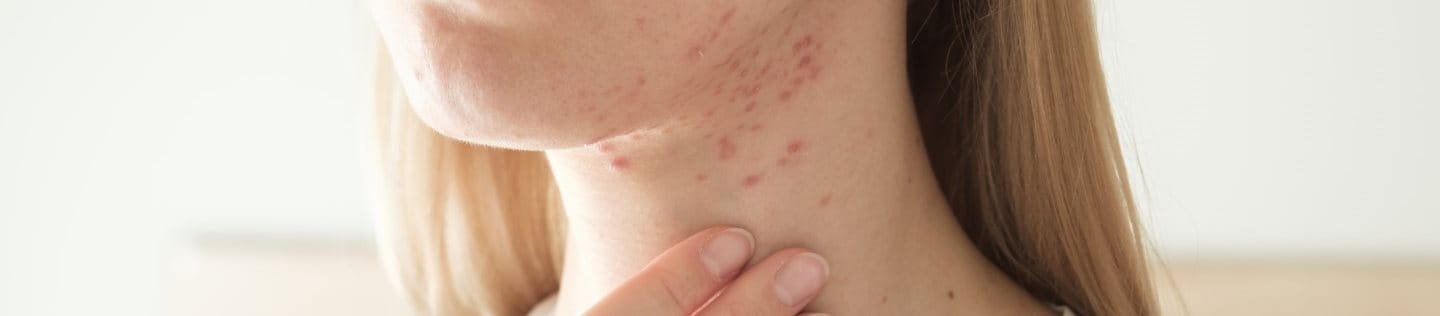 Ansicht auf die untere Gesichts- und Halspartie einer blonden Frau, mit Akne am Hals. Die Frau berührt mit den Fingerspitzen ihrer rechten Hand die Haut unterhalb der Pickel am Hals.