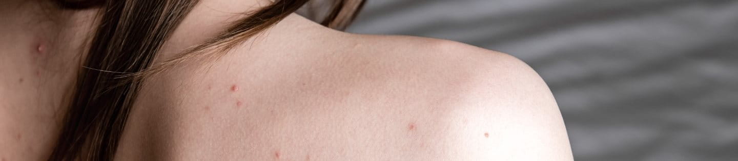 Ansicht einer Frau von hinten mit Pickeln auf Rücken und Schultern.