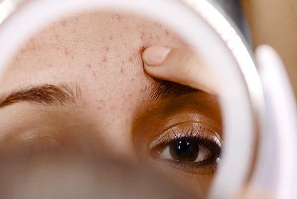 Spiegelbild einer Frau mit Akne