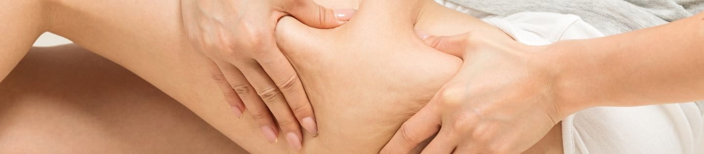 Cellulite am Oberschenkel einer Frau.