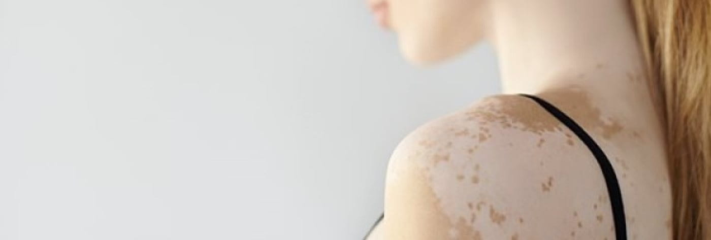 Junge Frau mit Vitiligo (Weißfleckenkrankheit)