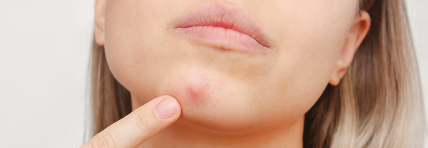 Gros plan sur une femme montrant du doigt un bouton sur son menton.