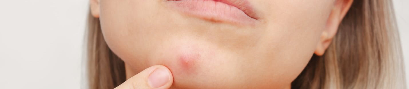 Unterirdische Pickel am Kinn